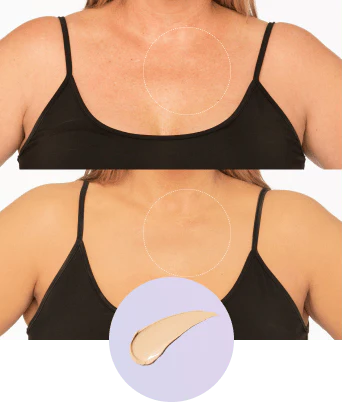 Vitiligo